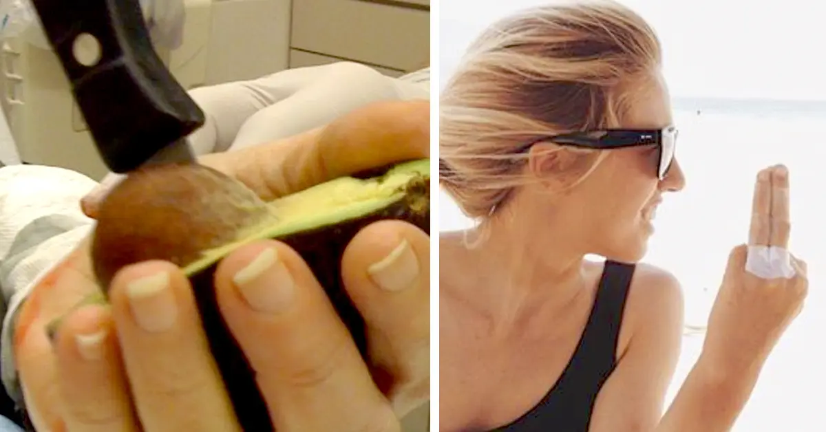 4 Imágenes del fenómeno de «La Mano de Aguacate» que se está convirtiendo en una pesadilla para los hospitales